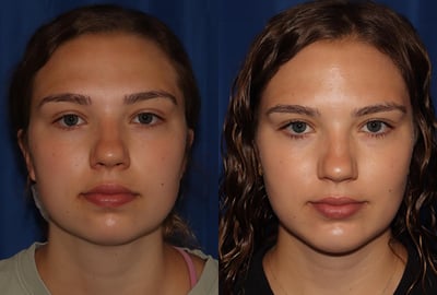 Front View Chin Implant & Liposuction before and after photo by Dr. Wick featured