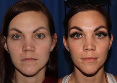 Front View Eyebrow Hair Restoration before and after photo by Dr. Wick