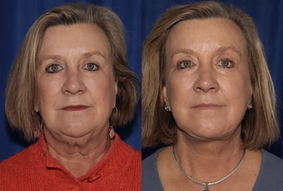 Front View Multilift before and after photo by Dr. Wick