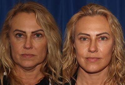 Front View Multilift before and after photo by Dr. Wick featured