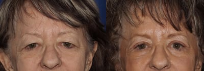 Front View Upper Eyelid Surgery before and after photo by Dr. Wick